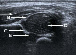 Hip Ultrasound Scan