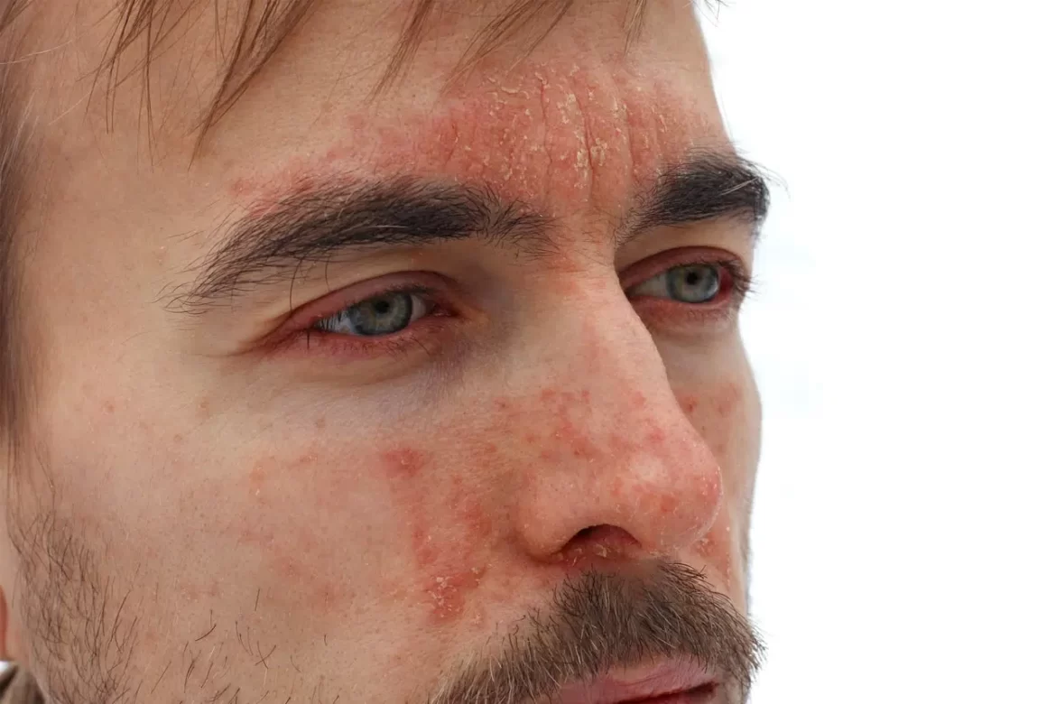 Seborrheic Dermatitis